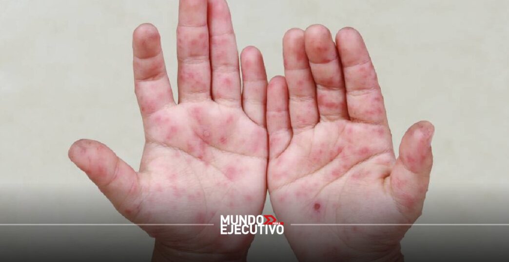 virus coxsackie Puebla