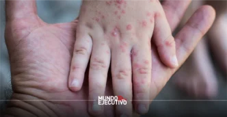 Brote de virus Coxsackie afecta escuelas en Puebla