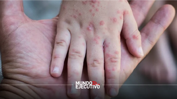 Brote de virus Coxsackie afecta escuelas en Puebla